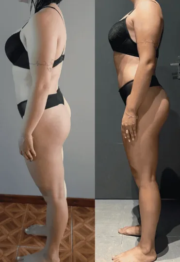 Antes e depois — Ana Paula